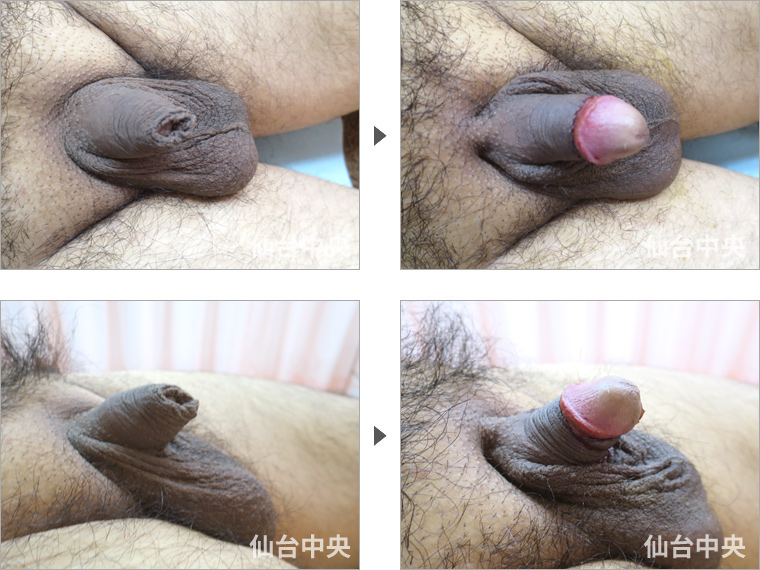 30代の包茎手術 症例写真1