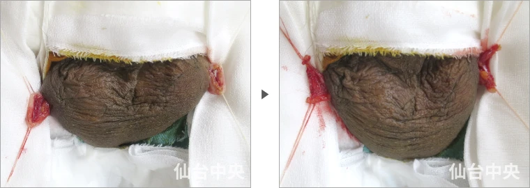 パイプカット症例写真1 精管の露出と切除
