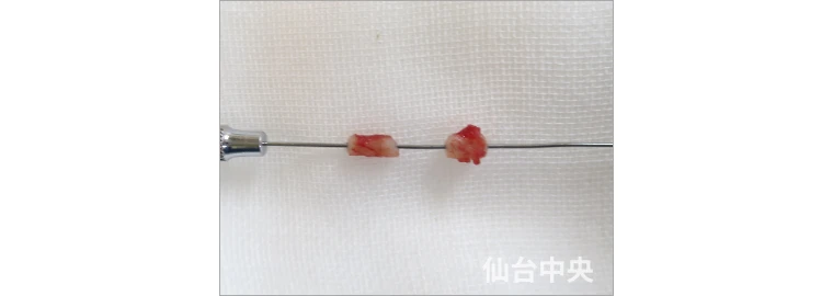 パイプカット症例写真1 切除した精管の確認