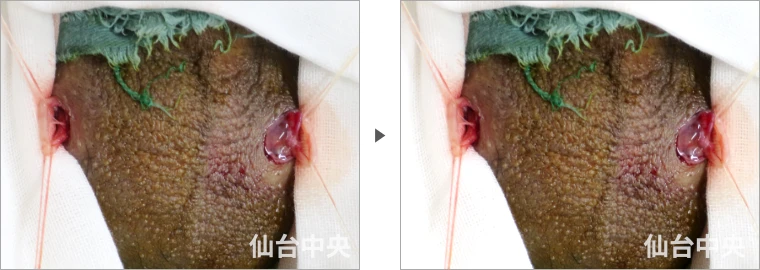 パイプカット症例写真2 精管の露出と切除