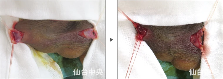 パイプカット症例写真3 精管の露出と切除