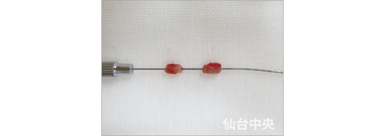 パイプカット症例写真3 切除した精管の確認