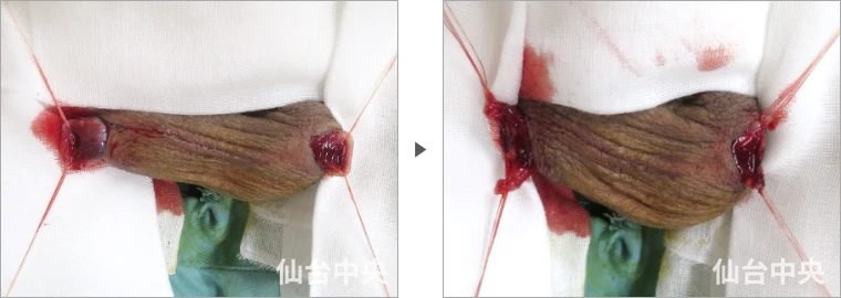 パイプカット症例写真5 精管の露出と切除