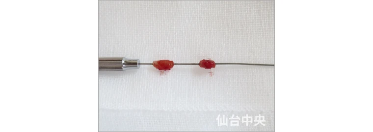 パイプカット症例写真5 切除した精管の確認