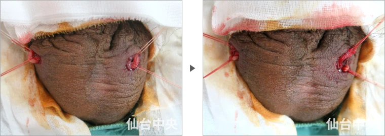 パイプカット症例写真6 精管の露出と切除