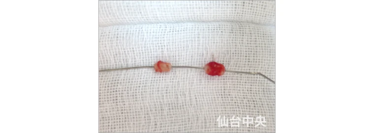 パイプカット症例写真6 切除した精管の確認